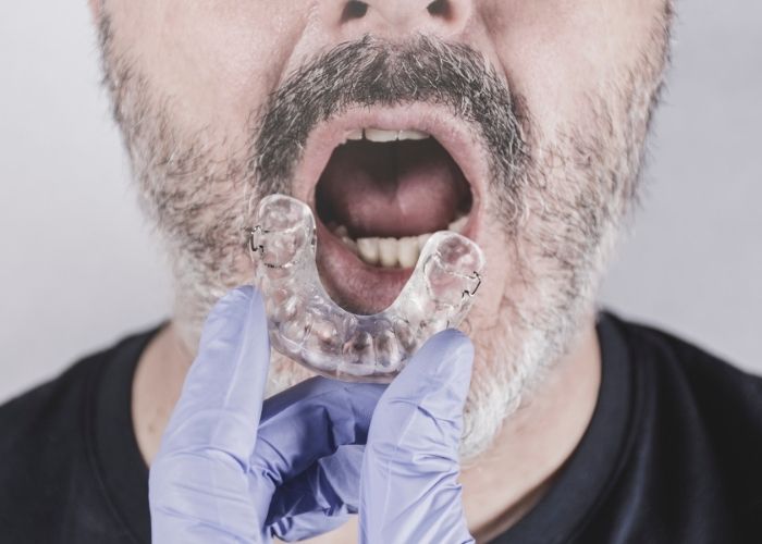 Custom mouthguards for bruxism and TMJ pain