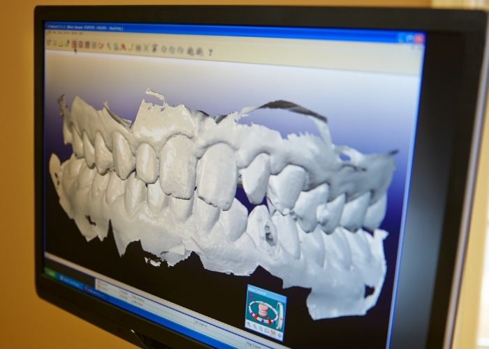 How are custom mouthguards made