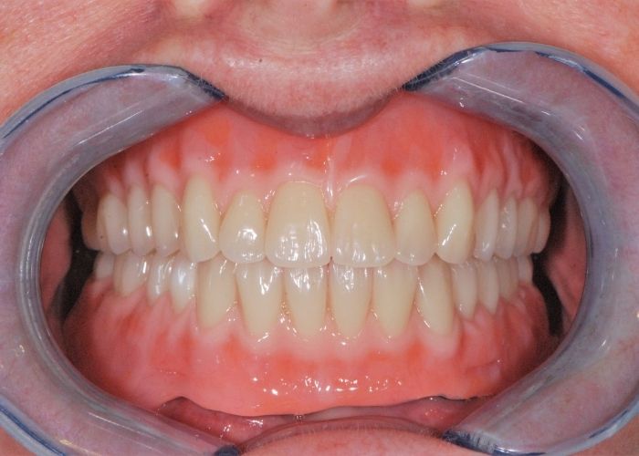 Pros and Cons of Dentures Pros and Cons of Dentures