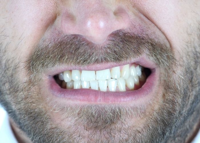 Signs of Bruxism