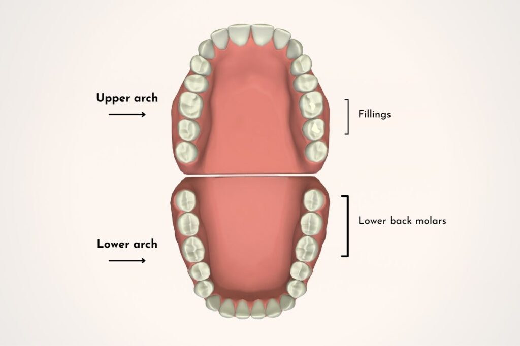 Why Do My Teeth Chip So Easily? Kelmscott Dental