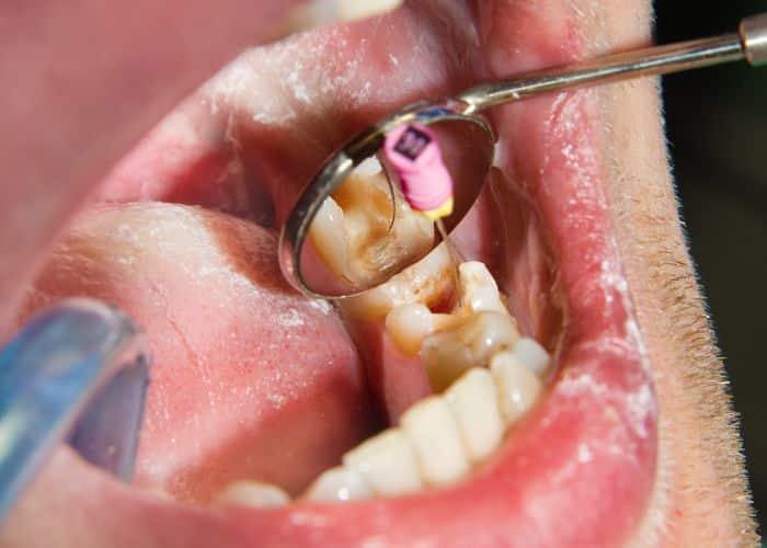 Root-canal-therapy