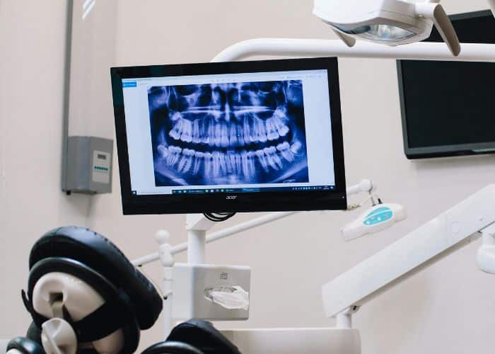 Wisdom-tooth-removal-risks (2) Wisdom-tooth-removal-risks