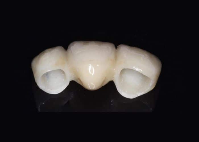 Dental bridge Dental bridge