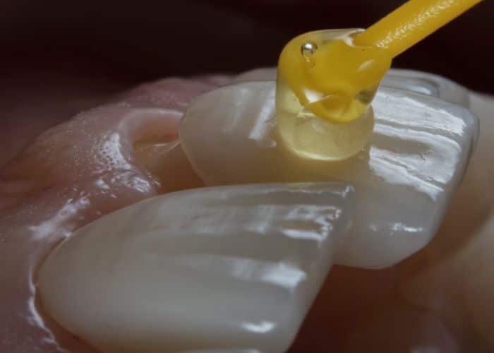 Risks-with-veneers Risks with dental veneers